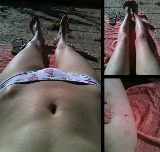 Sunshine and Scarring